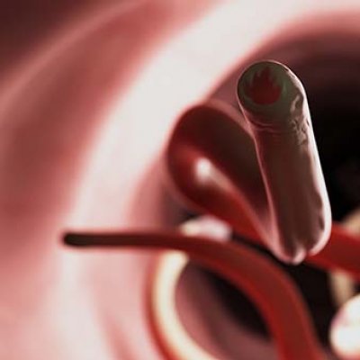 An artist's impression of hookworm inside a human intestine.